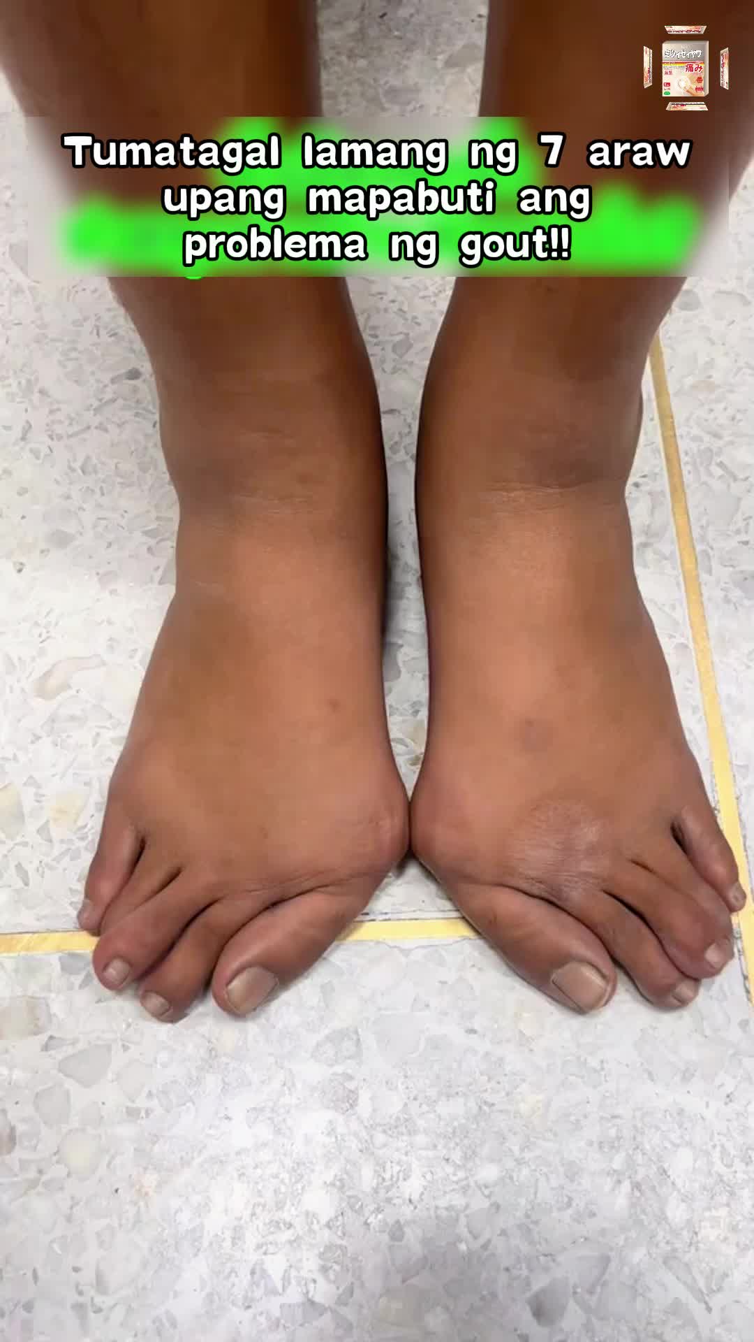 Try it now and experience the relief you've been looking for #GoutPatch #GoutRelief #JointCare #HealthyLiving #gout #goutpatch #patch#wy