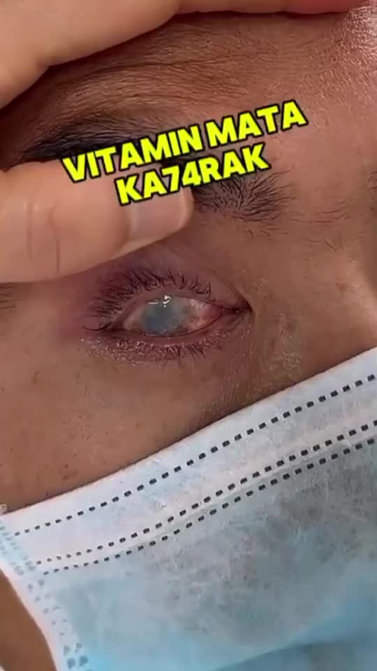 Eye drops 13ml Eye katarak eye drop Eye kering Sakit Eye Darah Merah Ketegangan Eye Presbiopia Katarak Eye gatal Glaukoma Floaters