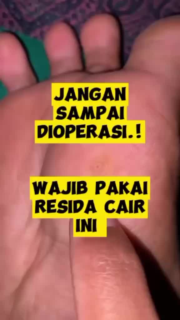 RESIDA CAIR Untuk Mengatasi Jamur Kulit Penganti Kalpanak