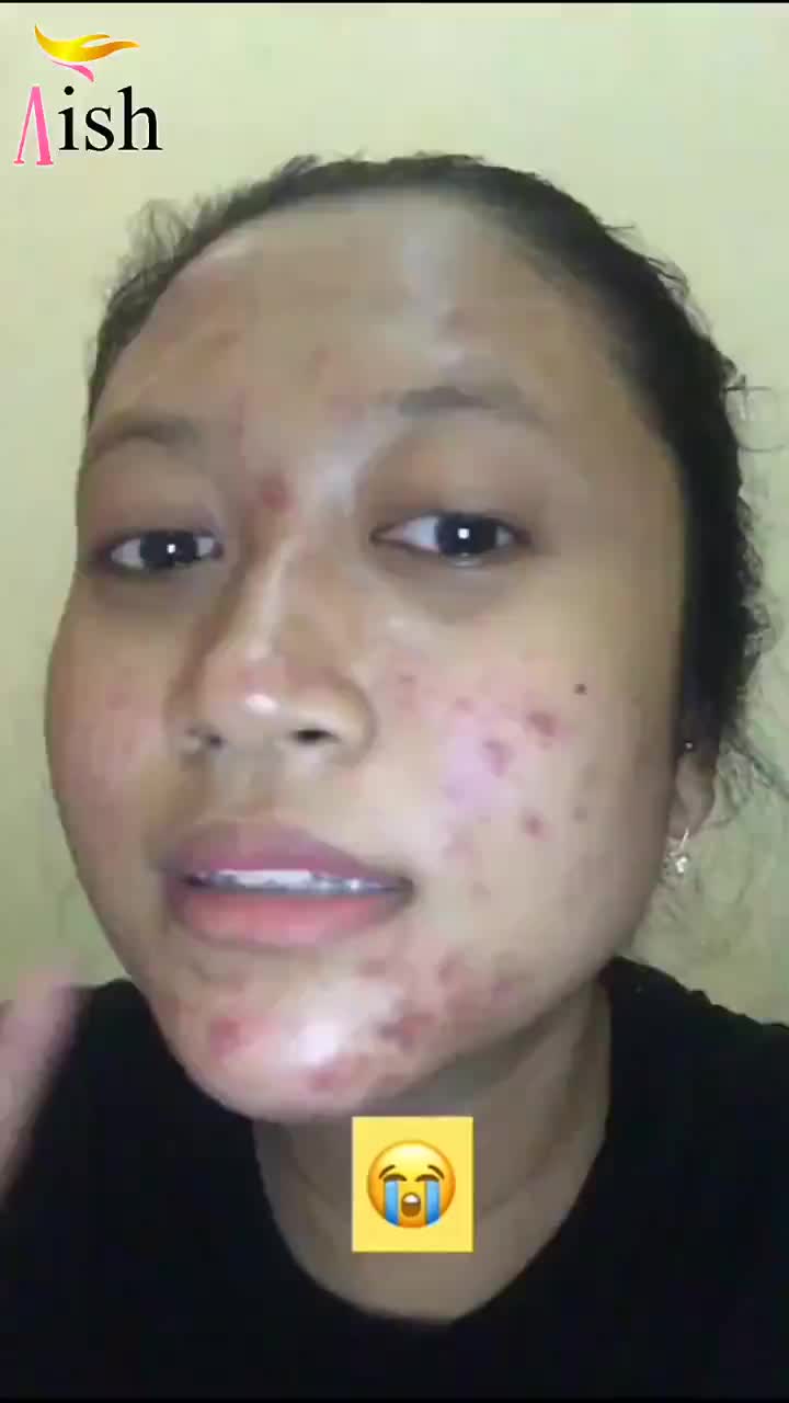 AISH DARKSPOT SERUM - Untuk Flek dan Bekas Jerawat Original 15 ml BPOM