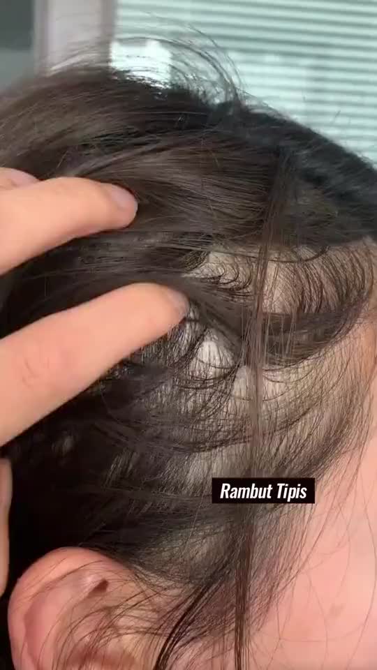 AHE Hair Fall Treatment Shampoo Anti Rambut Rontok Berminyak Dan Berketombe 300 ML